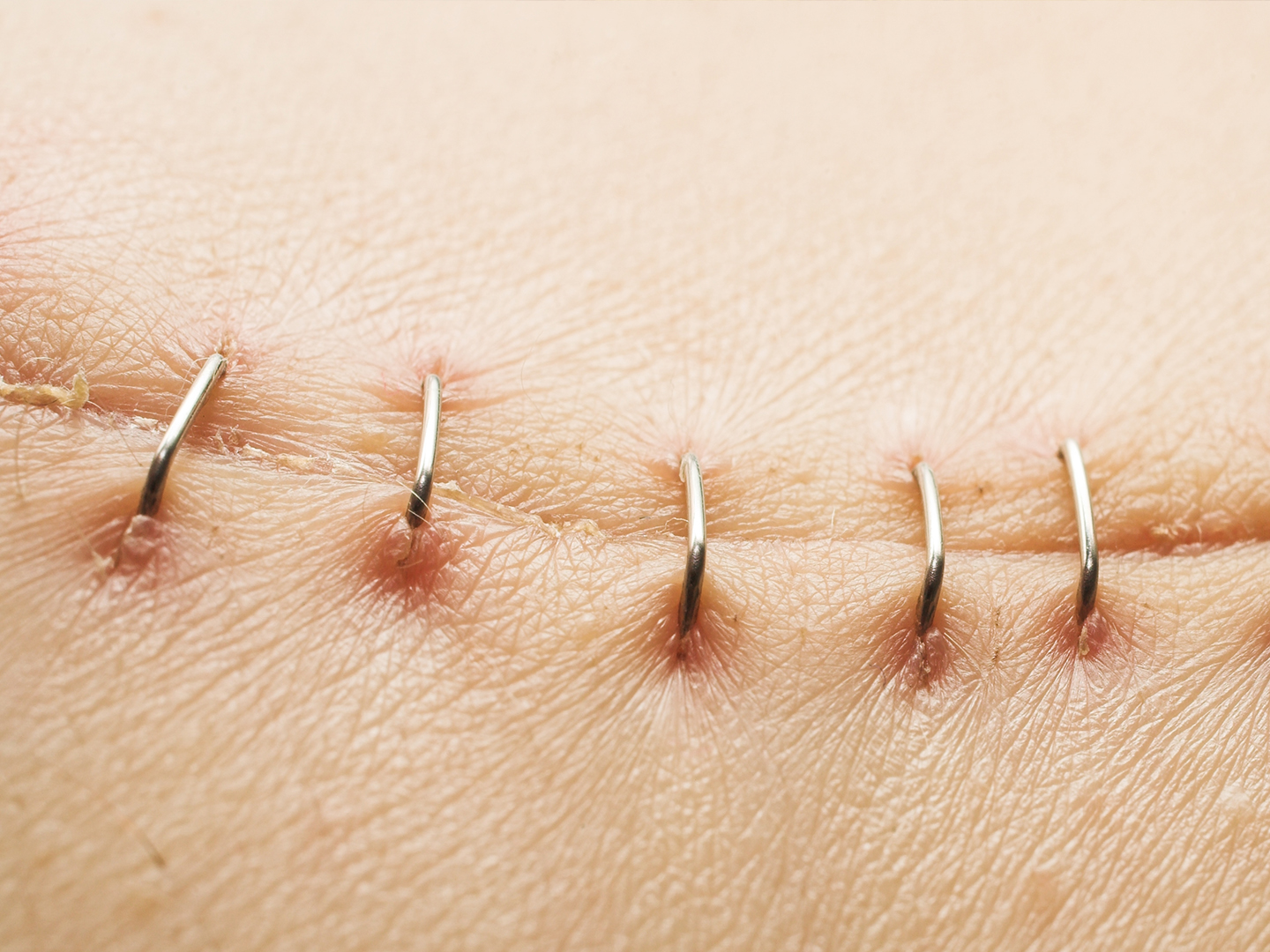 treating post-surgery wounds