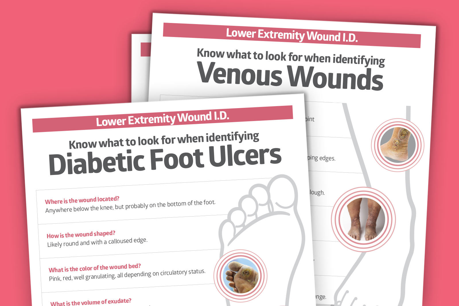Preview of three lower extremity wound I.D. posters. Preview of three lower extremity wound I.D. posters.