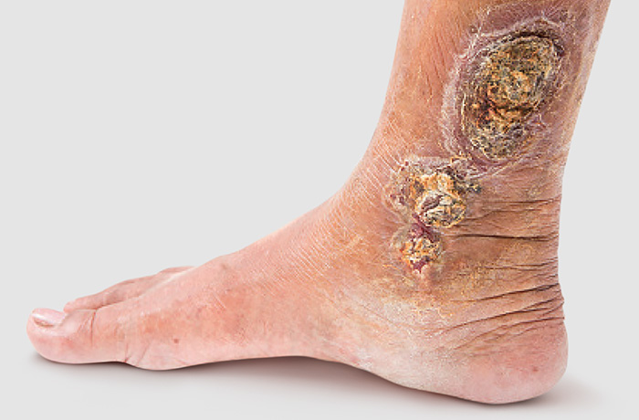 STK_Venous Wound