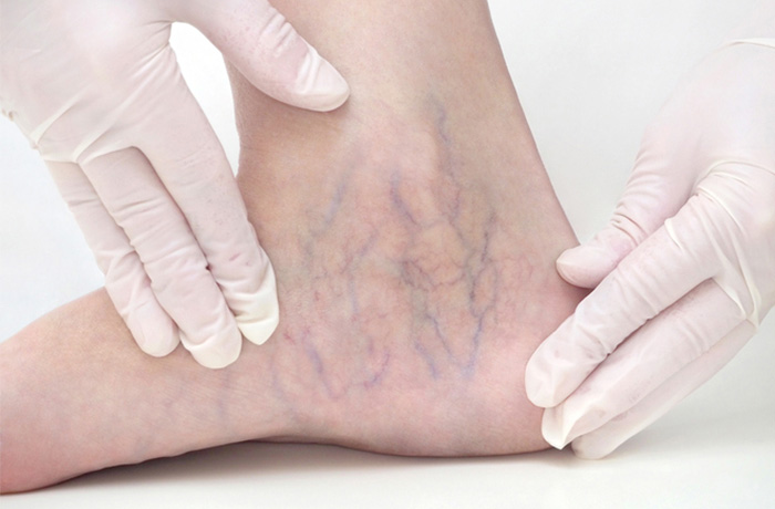 STK_Venous assessment