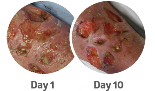 Wound at day one and day 10 of treatment with PluroGel Wound at day one and day 10 of treatment with PluroGel
