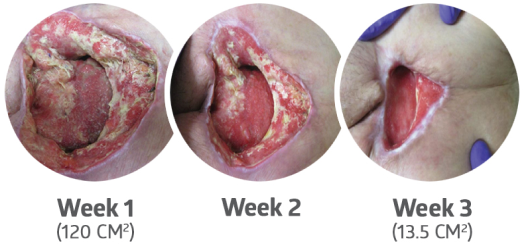 Wound at week 1, 2 and 3 of treatment with PluroGel Wound at week 1, 2 and 3 of treatment with PluroGel
