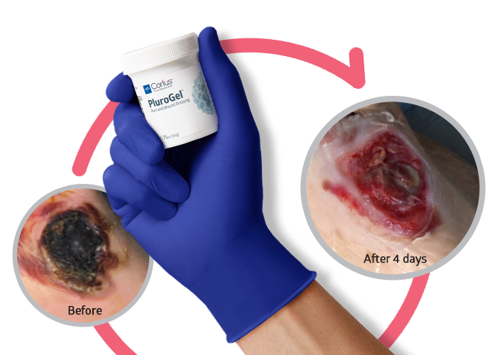 Gloved hand holding jar of PluroGel with insets of wound before and four days after using PluroGel to manage biofilm