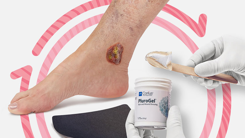 Open ankle wound next to clinician scooping PluroGel and IoPlex dressing inside Skin Health logo.