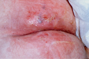 STK_IAD wound