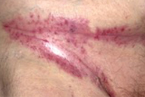 STK_ITD wound