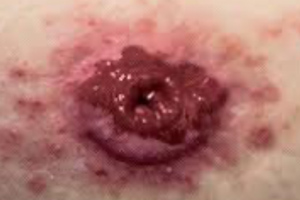 STK_Peristomal wound
