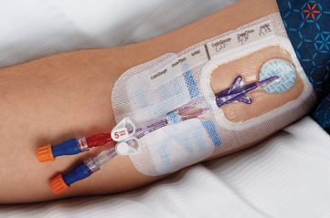 SKU_BSIIJ1000_BSI Cover_007 1 (1) Closeup of patient's arm with central line catheter secured by a clear dressing