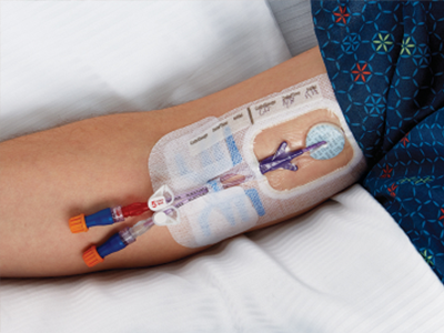 STK_MDPI_catheters_patients