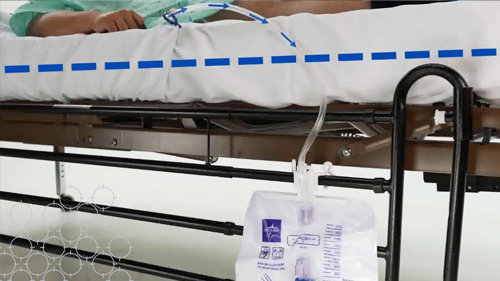 Patient bed with catheter system attached