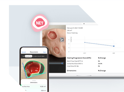 Images on smart phone screen and laptop of sample data from NE1 Wound Management System