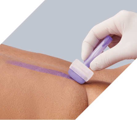 Caregiver’s gloved hand applies Marathon XL to patient’s back with wide applicator.