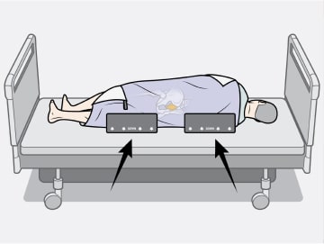 Educational diagram showing how to offload sacrum with wedges