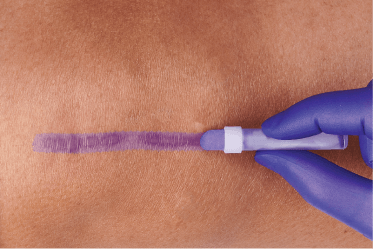 violet-tint Caregiver’s gloved hand applies violet-tinted protective film to affected area, which lasts up to 72 hours