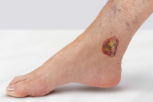 HeelMedix Advanced Heel Protector with instructional toe/heel printing applied to patient’s heel in hospital bed