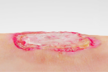 HeelMedix offloading boot with color-coded strap for foot protection