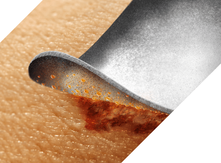 Clinician’s gloved hand applies Marathon XL to patient’s skin with wide applicator