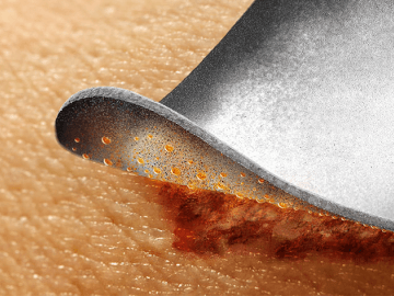 Close-up of IoPlex dressing on skin