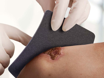 Clinician applying IoPlex™ dressing to patient wound