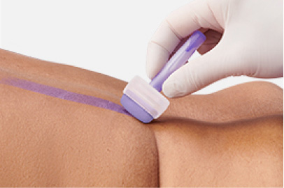 robust-barrier Clinician applying Marathon to patient skin
