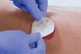Clinician’s gloved hands, applying collagen dressing to patient wound