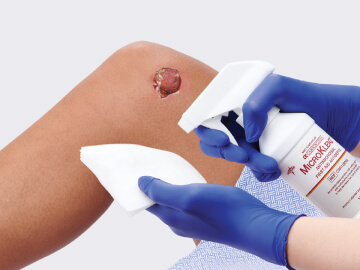 Clinician’s sprays antimicrobial antiseptic onto cloth to help prevent bacterial contaminants in patient’s open wound
