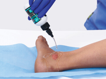 Clinician applies an antimicrobial preservative to patient’s ankle 