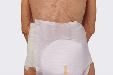 Backside of elderly patient wearing disposable brief to protect against prolonged exposure to bodily fluids