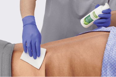 Clinician applies cleanser designed for skin that is more vulnerable due to certain risk factors like incontinence