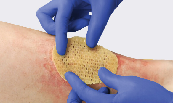Wound dressing with medical-grade honey being applied to patient’s open wound