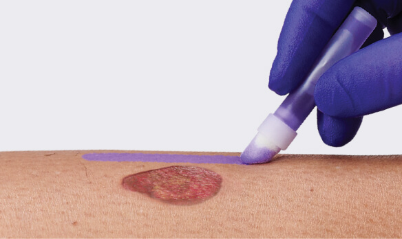 Clinician applies purple barrier to patient’s skin