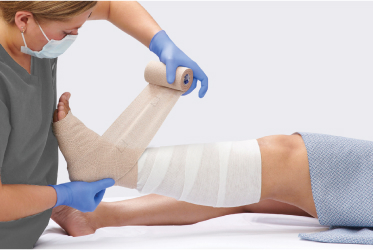 Clinician’s gloved hand applies iodine dressing to a knee wound with a chronic infection