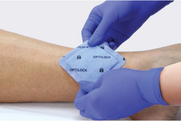 Clinician’s gloved hand applies PluroGel to a dressing, preparing to apply it to a leg wound with microbial biofilms