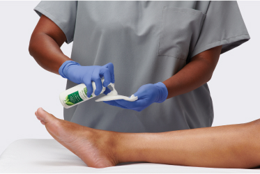 Clinician’s gloved hand applies dressing with antimicrobial agents to a wound with biofilm infection