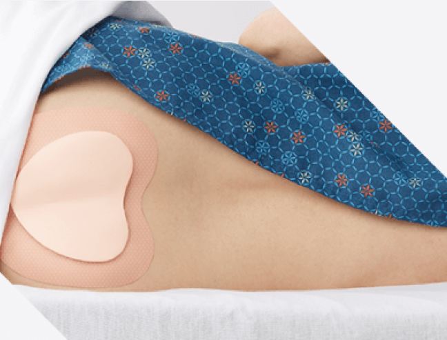 Clinician’s gloved hand applies Marathon XL to patient’s skin with wide applicator