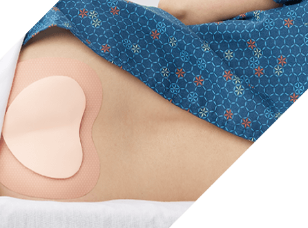 Clinician’s gloved hand applies Marathon XL to patient’s skin with wide applicator