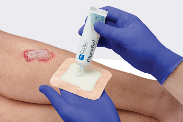Clinician’s gloved hand applies dressing with antimicrobial agents to a wound with biofilm infection