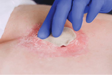Clinician’s gloved hand applies iodine dressing to a knee wound with a chronic infection