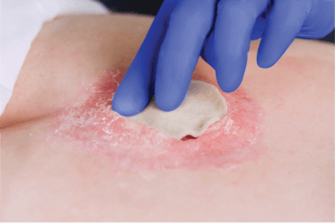 Clincian’s gloved hand places a fiber dressing in the wound bed on patient’s lower back