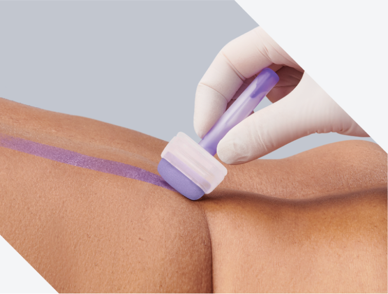 Clinician’s gloved hand applies Marathon XL to patient’s skin with wide applicator