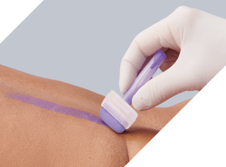 Clinician’s gloved hand applies Marathon XL to patient’s skin with wide applicator