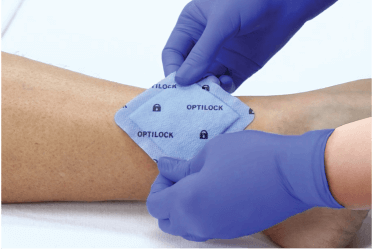 Clinician’s gloved hands apply a heavy exudate wound dressing to patient’s ankle