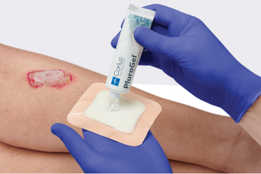 Clinician’s gloved hand applies PluroGel to a dressing, preparing to apply it to a leg wound with microbial biofilms