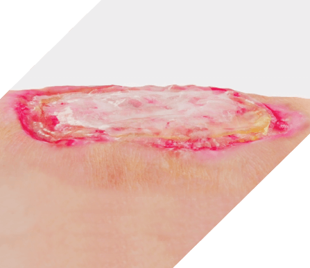 An infected wound that shows biofilm formation