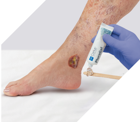 Clinician applies a chronic wound care product to treat patient’s non-healing wound with biofilm