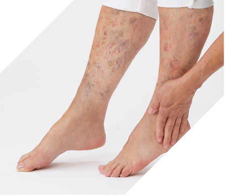Patient touches leg, showing visible signs of venous stasis disease