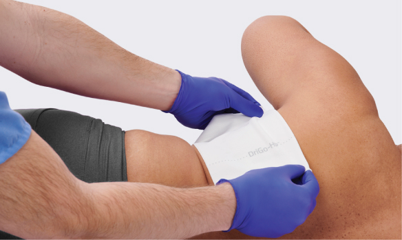 Clinician applies sheet to bariatric patient to protect against skin conditions like intertriginous dermatitis (IAD)