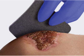 Clinician applies an iodine dressing, a chronic wound treatment, to a non-healing wound on patient’s knee