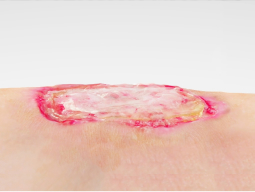 An infected stalled wound that contains bacterial biofilm