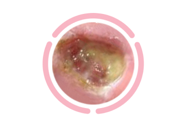 Iodine dressing turns white to indicate time for removal and peels back from wound
